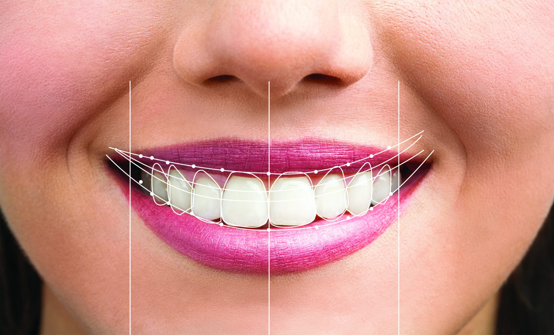 Smile Designing Treatment
